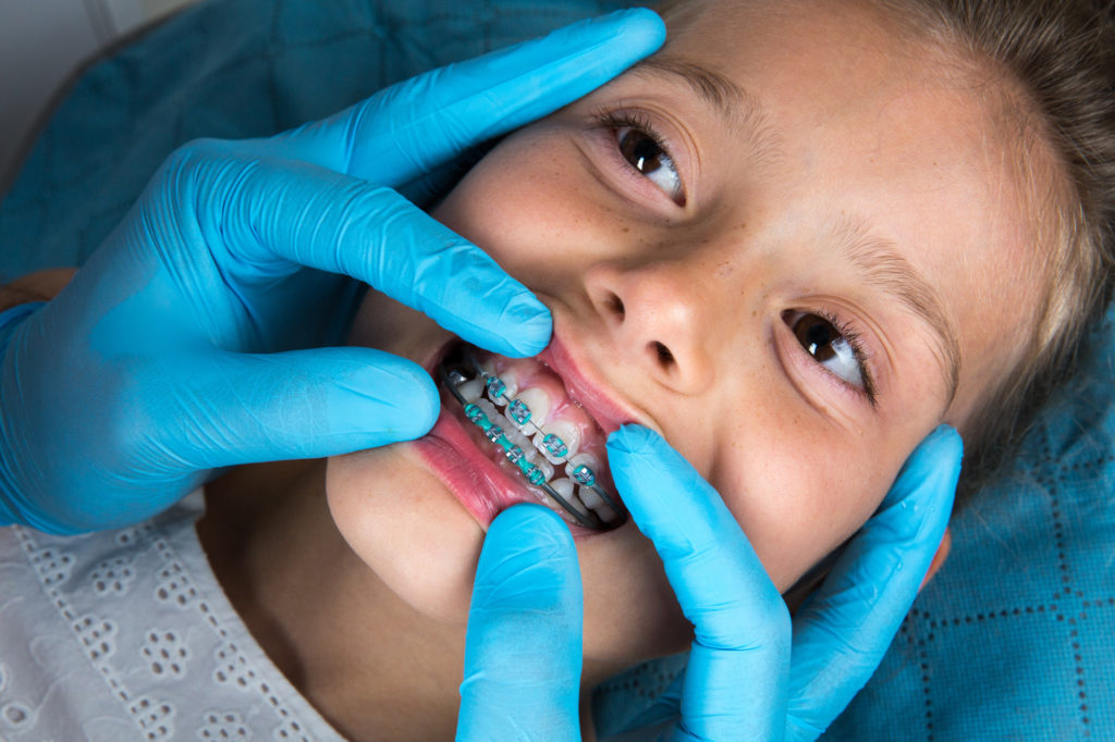 Does Your Child Need Braces: 9 Signs That Say They Do - Children&#39;s Dental &amp;  Orthodontics