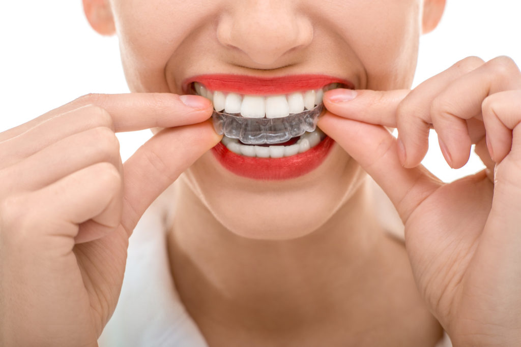 Can an Orthodontist in Dallas, TX Offer Invisalign Teen? 8 Things to Know